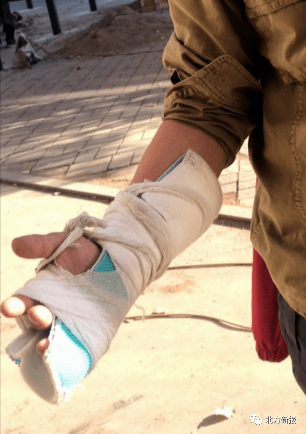 劝阻他人张贴小广告 呼和浩特一男子手指被掰骨折_石膏