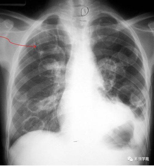 肺空洞ct图片图片