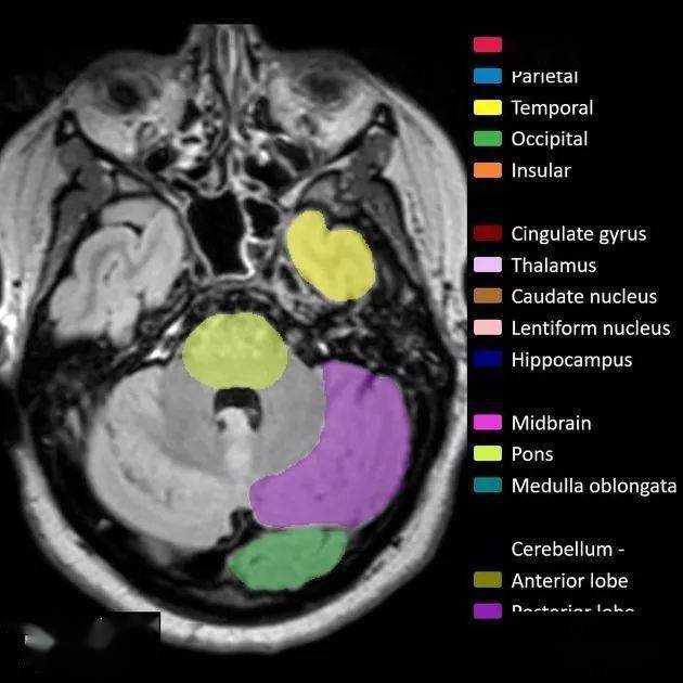 解剖丨脑叶分布(mri图像彩色标注)_lobes