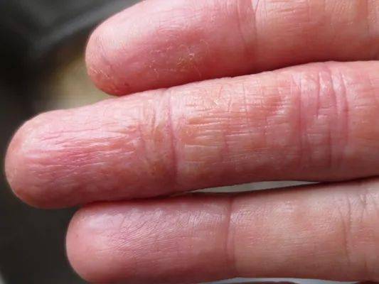 汗疱疹初期以米粒大小水疱为主,伴有不同程度的瘙痒;水疱破裂吸收后