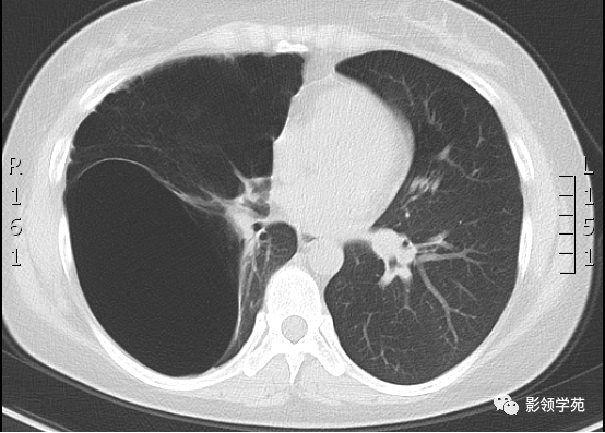 肺大疱影像图图片