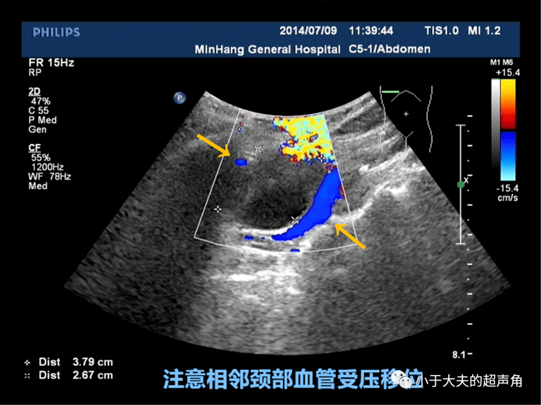 颈动脉体瘤超声表现图片