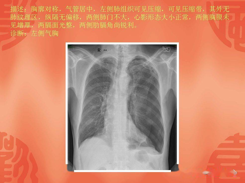 肺部气液平面图片