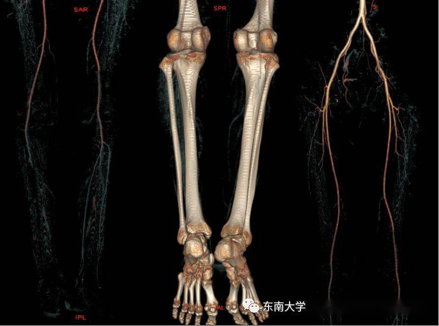 下肢动脉常见疾病的影像表现