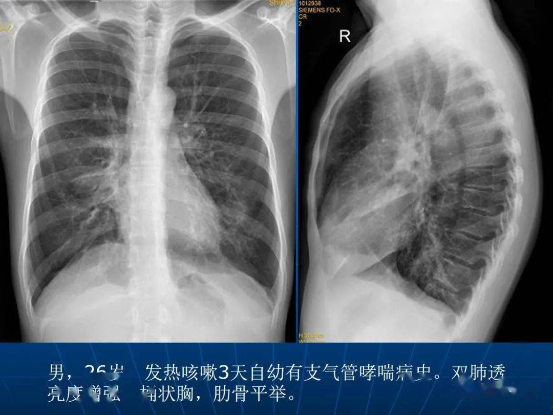 肺气肿的影像诊断