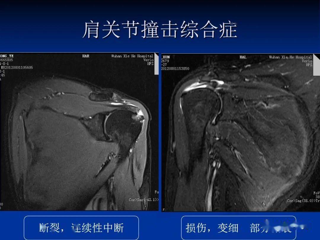 肩袖解剖及损伤的临床及mri诊断