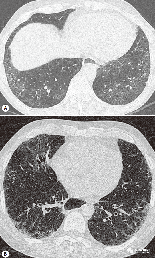 结缔组织病系统性血管炎药物诱发的肺疾病职业性肺疾病丨肺hrct表现