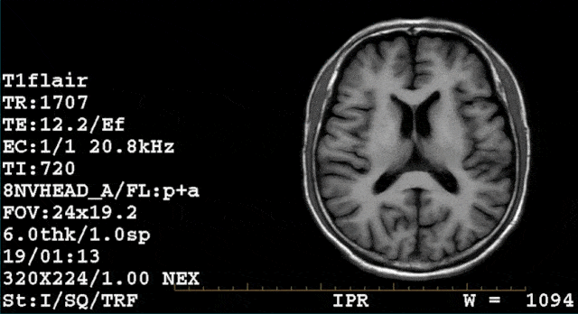 在关节扫描中,大部分fs序列都是扫描间于pdwi与t2wi间的中间权重序列.