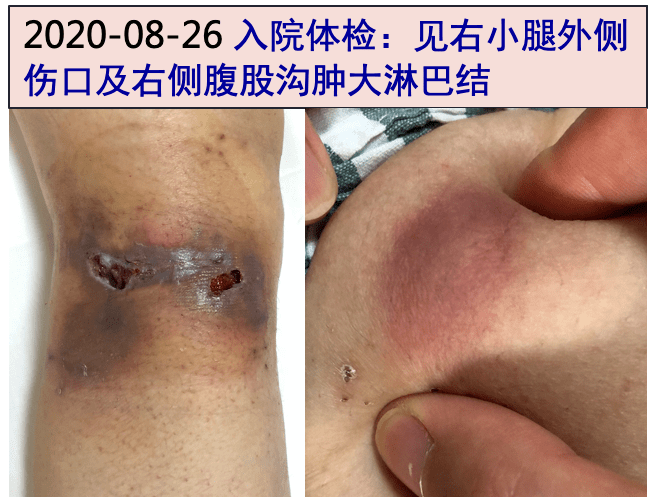 右側腹股溝可觸及腫大淋巴結,直徑2cm左右,質韌,邊界清;右小腿外側近