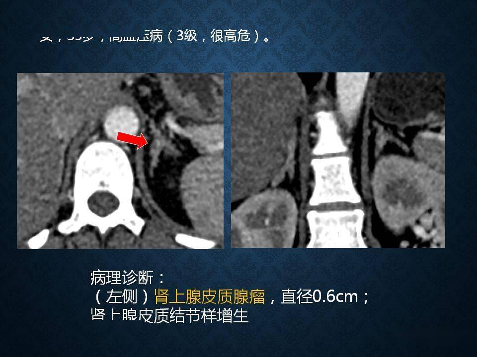 肾上腺丨扫描方案解剖皮质增生及小腺瘤的诊断