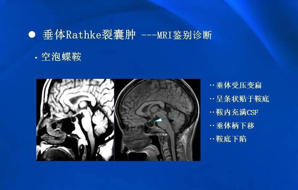 【影像】拉克氏囊肿的mri表现及鉴别诊断