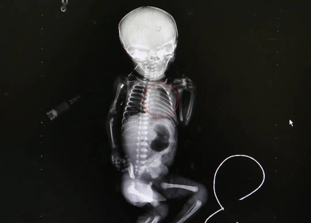 安安出生第一天的胸片安安出生第二天的胸片,红圈处白色阴影面积变小