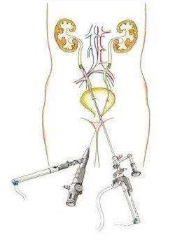 这种取石法让输尿管结石无处可藏