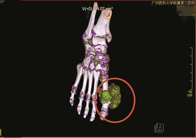 影像检查显示,患者大脚趾关节处长出鹅卵石大小的痛风石