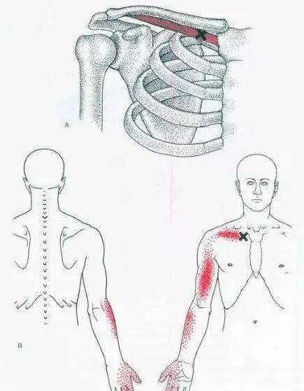 这些近端肌肉都会引起上肢麻木