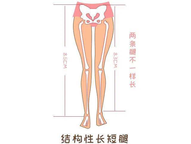 骨盆导致长短腿图片