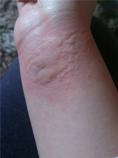 荨麻疹俗称风疹块.