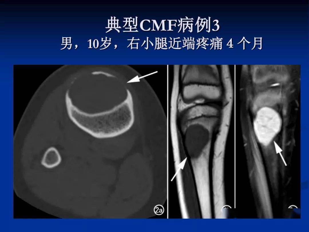 软骨粘液样纤维瘤影像学诊断