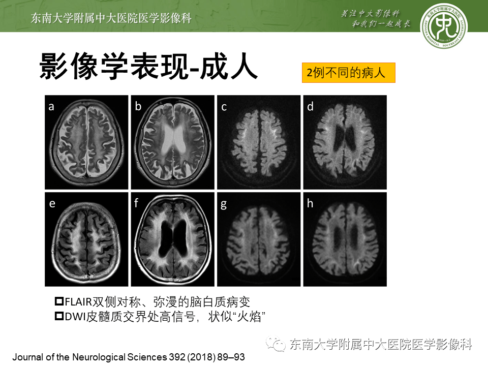 晨读结果公布20201102神经系统疾病神经元核内包涵体病