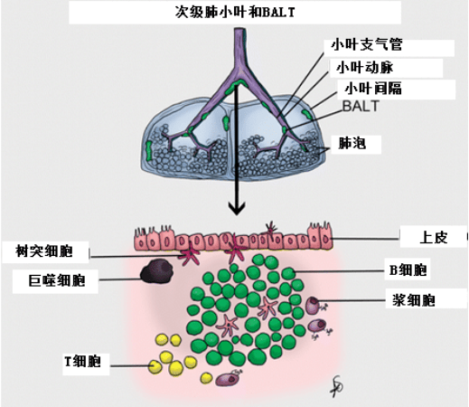 balt是由淋巴细胞(b和t细胞)的粘膜下集合组成的,分布在整个气道的