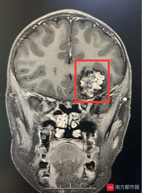然而,在行核磁共振檢查頭顱時,卻意外發現航航左顳額內側有佔位性病變