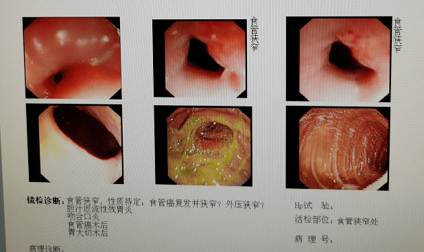 食管一线之光pd1单抗联合化疗用于局部复发食管癌应用4周期后即达pr