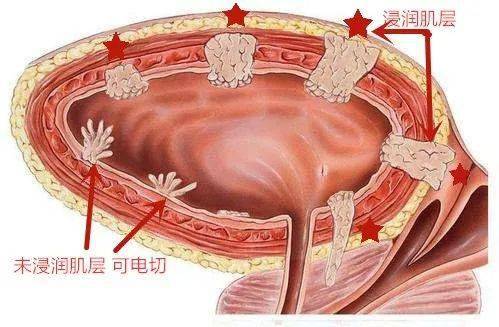 原来,李先生2016年被确诊为膀胱癌,他先后3次在外院进行了"经尿道膀胱