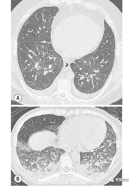 格艾选读丨肺水肿机制x线及ct表现
