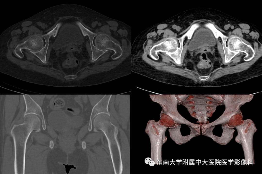 ct女,59岁,左髋部疼痛伴活动受限1年余,加重2月