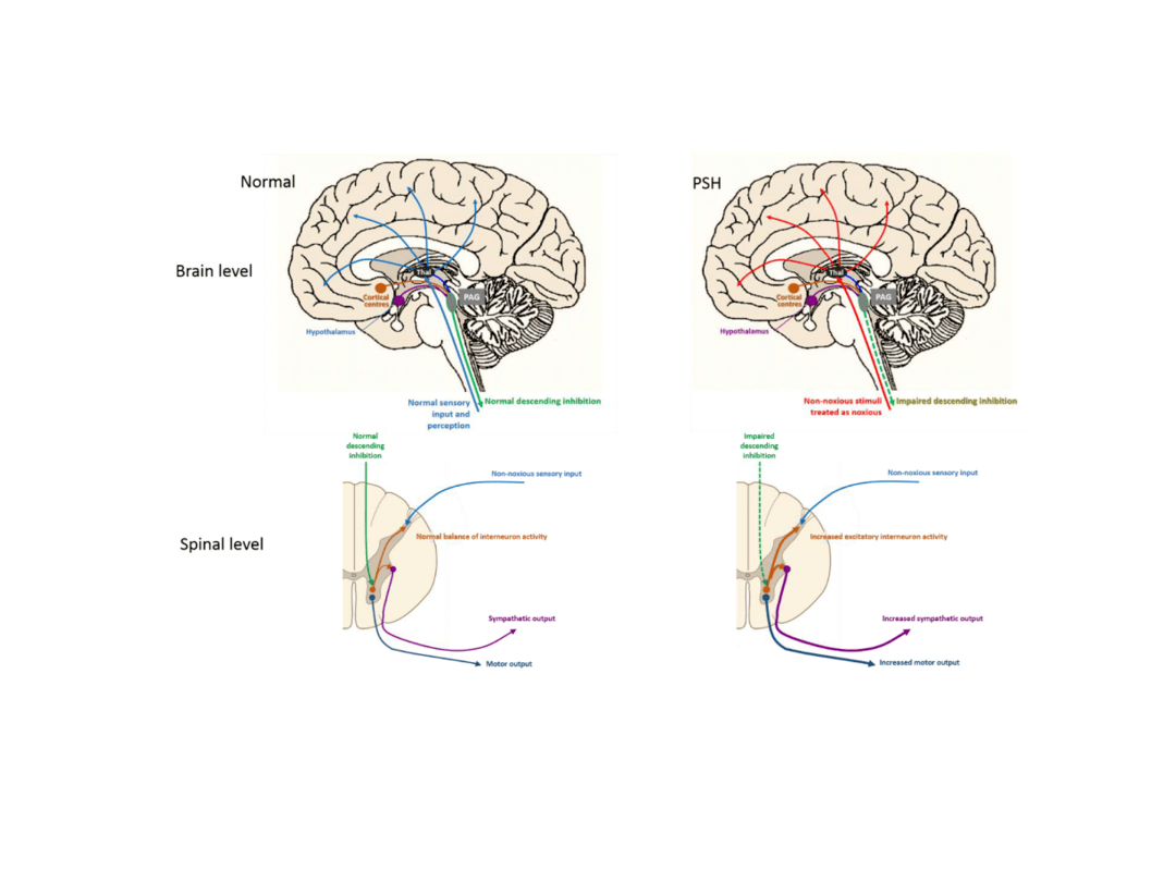 脑损伤后发作性交感神经过度兴奋
