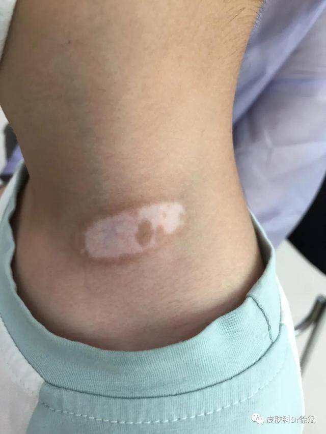 儿童白癜风,如何治疗才能安全快速见效?