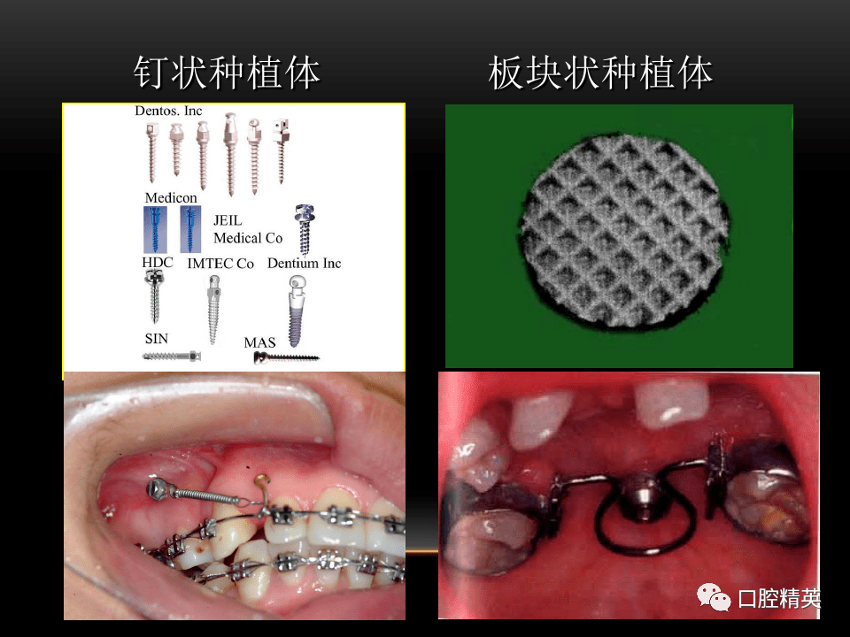 正畸治疗中的支抗控制