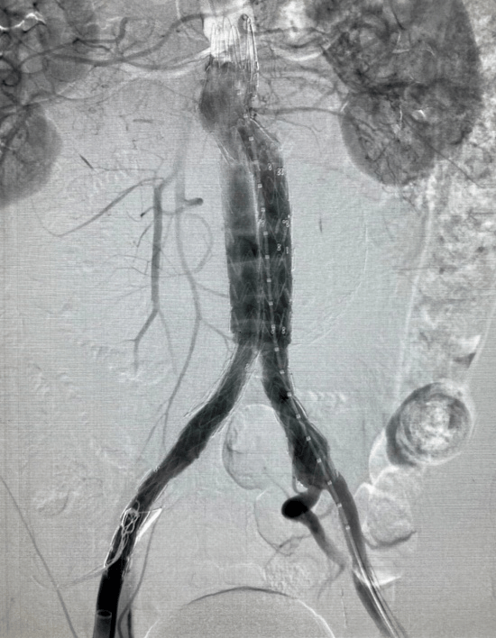 巨大腹主动脉瘤威胁患者生命 血管外科团队成功微创"拆弹"