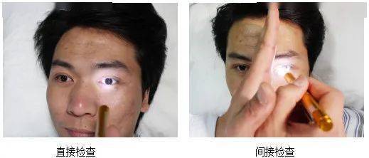 光照患侧瞳孔,两侧瞳孔均不反应;但光照健侧瞳孔两眼对光反射均存在