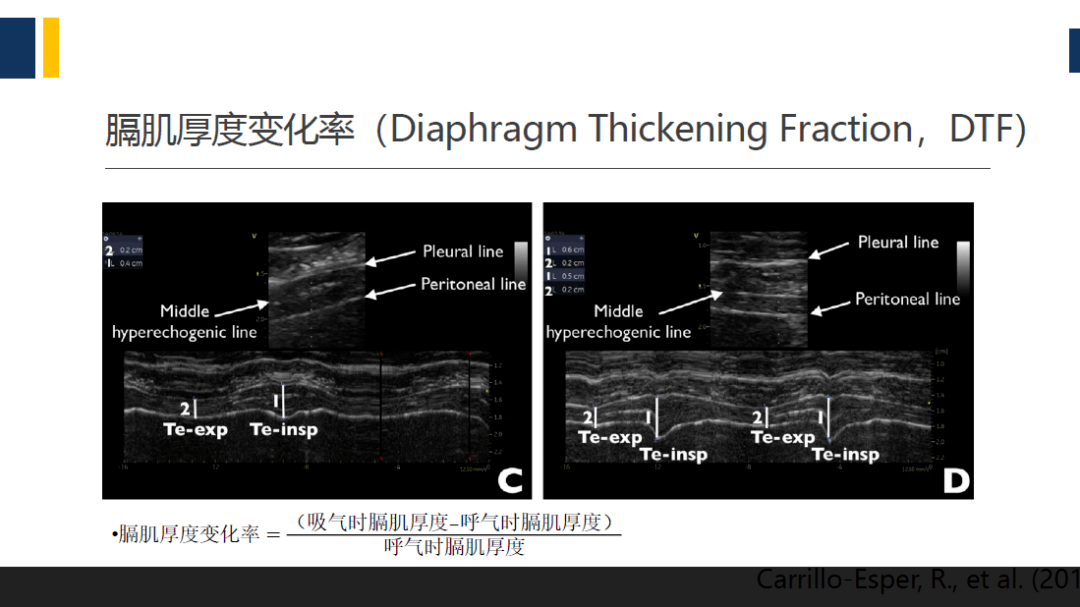 临床指南与知识更新膈肌超声的应用