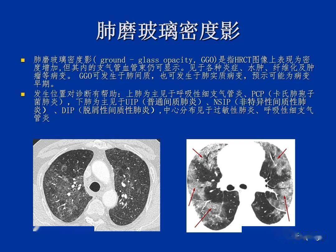 肺小叶,肺间质解剖与病变的hrct诊断