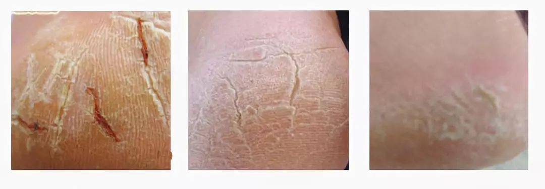 日本国宝马油告别皮肤皲裂脚气有效滋润双脚