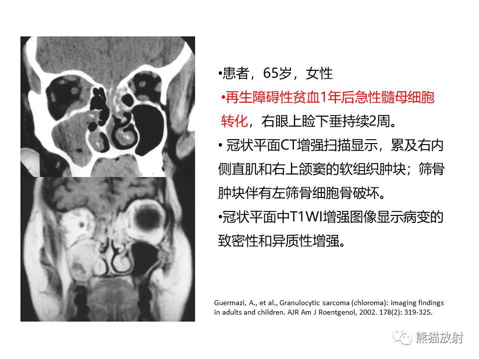 眼眶绿色瘤,淋巴瘤解剖丨颅面颈部(颅面骨,眼眶,腮腺,等)返回搜狐