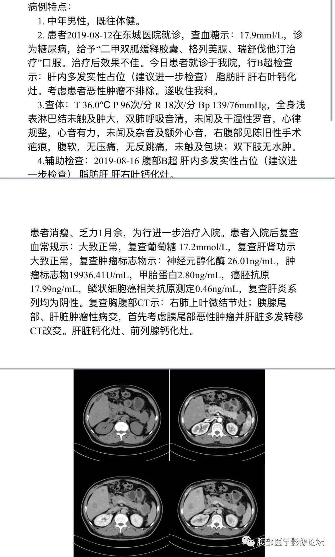 胰腺丨神经内分泌癌