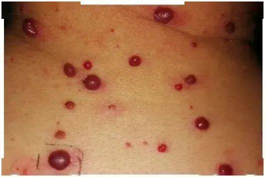 皮肤毛细血管增生症重型多型红斑性药疹大疱性类天胞疮另外,由于pd-1