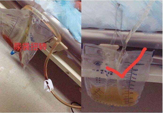 3步轻松解除尿管堵塞资深护士绝招大公开有图