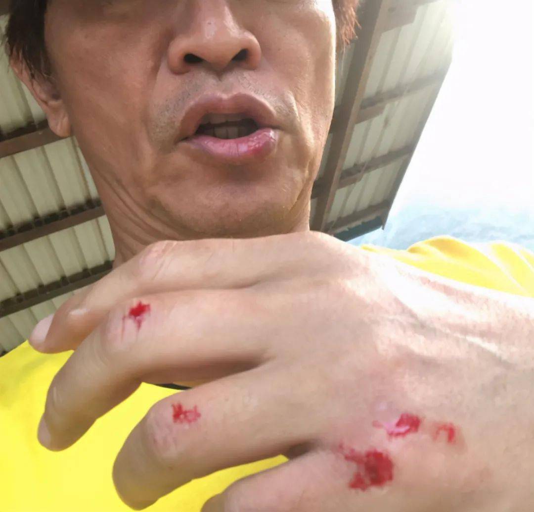 吴宗宪录节目意外摔车四肢绑满纱布头部撞击严重事发画面曝光