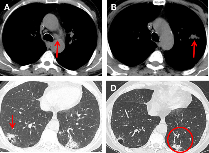 肺鳞癌晚期图片