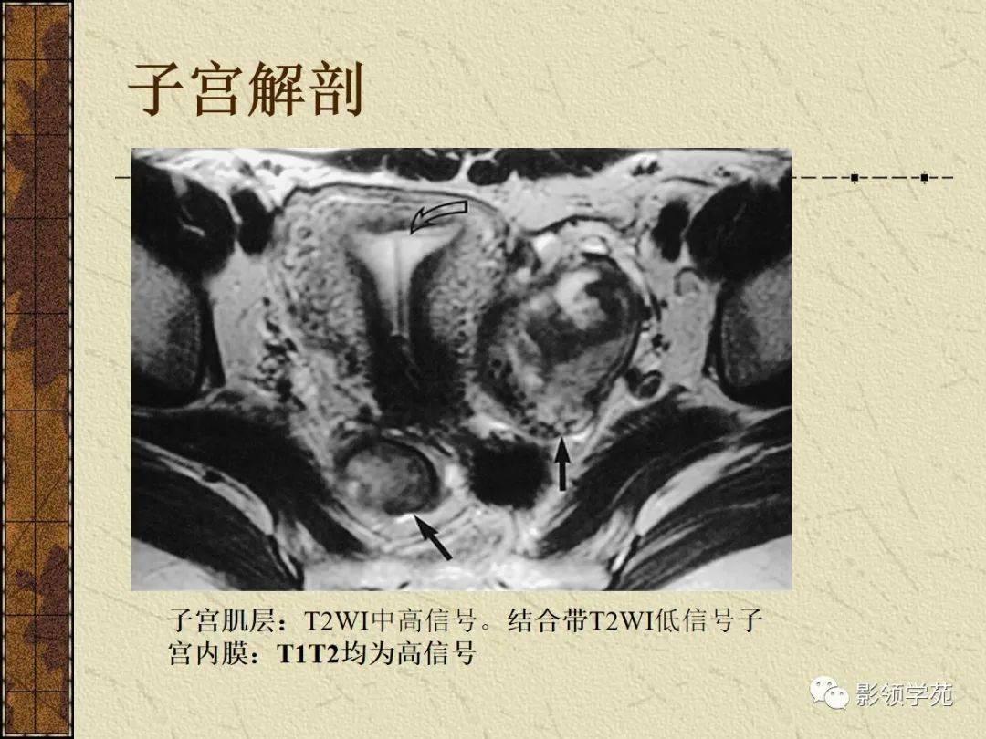 女性正常子宫附件CT图图片