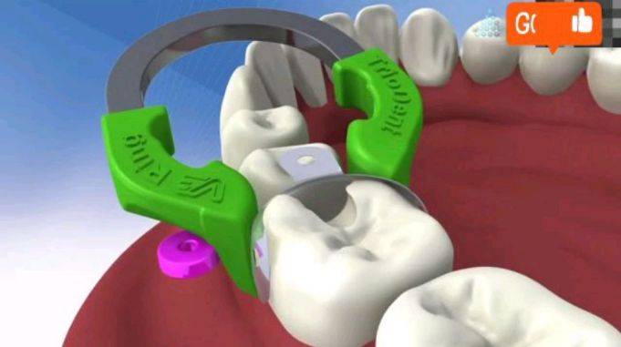 牙齿邻面洞补牙方法成型片的使用
