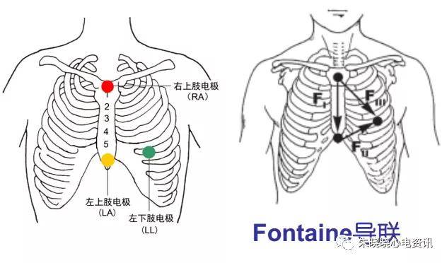epsiion波的心电图特征你掌握了吗