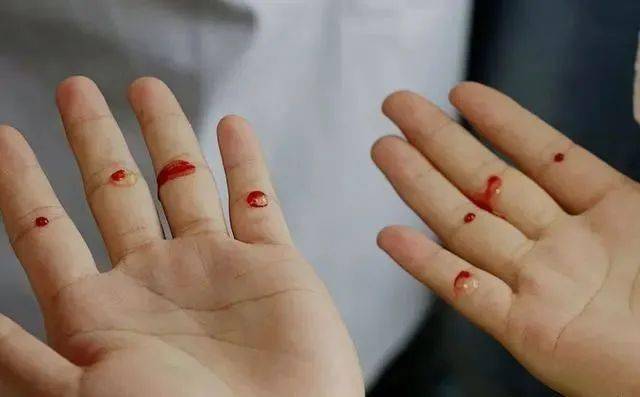 四缝穴扎一次见效二次痊愈真是绝了