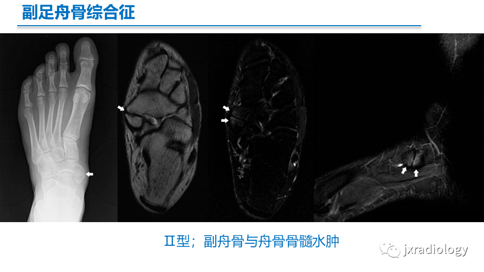 足副舟骨分型及相关病变的影像表现