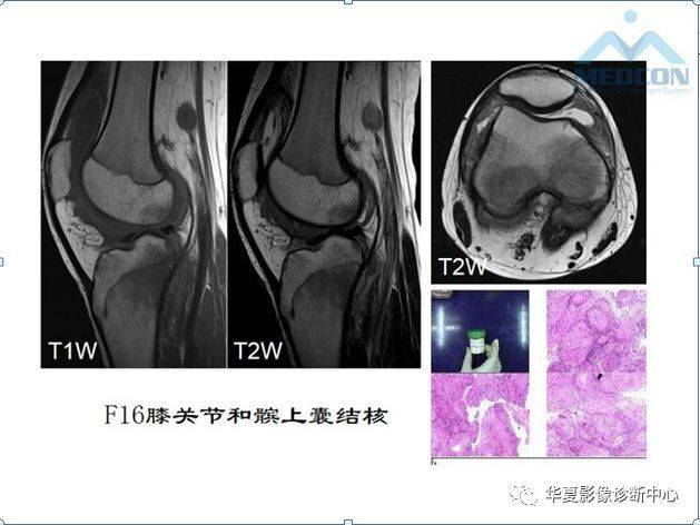 4大关节旁滑囊的精细解剖滑囊病变汇总