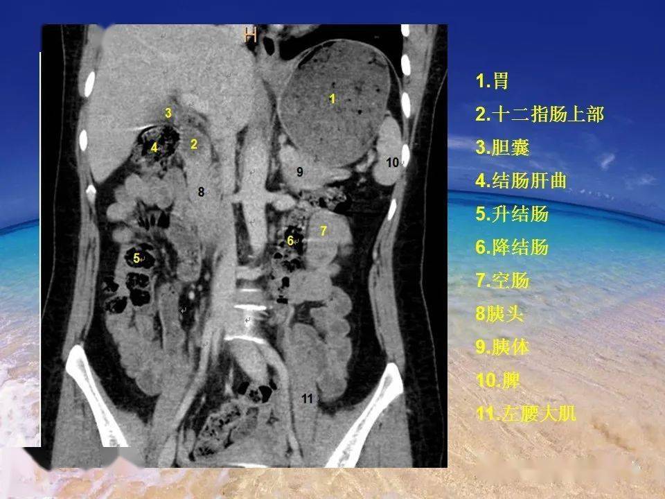 消化道穿孔的ct诊断